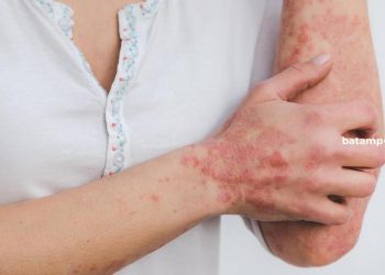 Kasus Pertama Varian Baru Mpox 1B Terdeteksi di Belanda