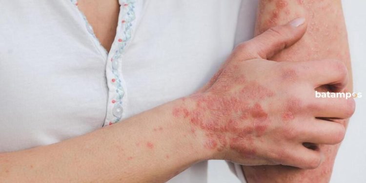 Kasus Pertama Varian Baru Mpox 1B Terdeteksi di Belanda